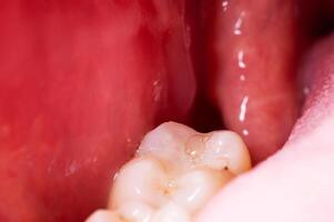 recess after complex impacted wisdom tooth extraction, traumatic healing. Dry socket, alveolitis, macro. Copy space for text photo
