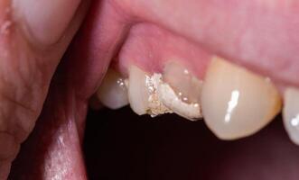 Tooth with temporary filling for nerve destruction and pulpitis treatment, macro. Dentistry photo