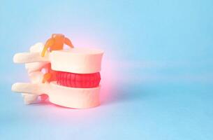 Mock up of a human spine with an inflamed intervertebral hernia on a blue background. Copy space for text photo