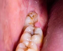 Impacted wisdom tooth due to which a gum hood was formed. Inflammation of the gums due to an unerupted molar, macro photo