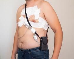 An obese man undergoes a Holter monitoring of the heart. A modern method for studying the heart in caodiology. Arrhythmia and ischemic disease. Medic photo