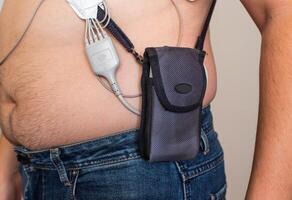 An obese man undergoes a Holter monitoring of the heart. Control of blood supply and disorders of the heart after myocardial infarction, electrocardiogram photo