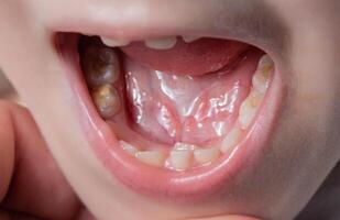 A permanent molar in a child grows second row. Incorrect growth of molars or polyodontia in dentistry, close-up photo