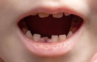 The open mouth of a child without one tooth. Loss of milk teeth. Close-up, deciduous teeth photo