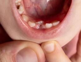 The child has a wrong tooth. Eruption of a permanent tooth in children, close-up photo