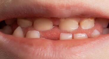 The smile of a child without one tooth in the jaw. Loss and removal of milk teeth in children, macro. Deciduous teeth photo
