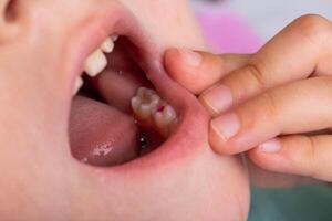 Installation of a colored red filling in a milk tooth for a child. Colored fillings in dentistry for children. Treatment of pulpitis and deep caries, close-up photo