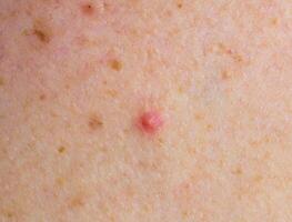 Red pimple on face macro, abscess and acne photo