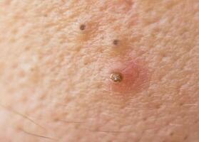 Black dots on face and pimples macro, comedo photo