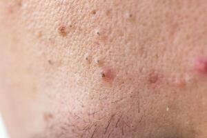 Black dots on face and pimples macro, comedo photo