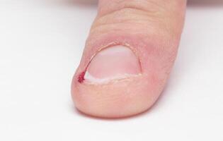 Male finger with torn burr and nail with blood, nail biting, white background, injury, copy space, macro photo