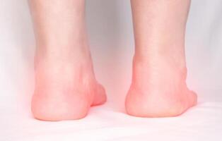 Legs of an adult woman on a white background with heel spurs, close-up, plantar fasciitis, orthopedist photo