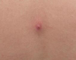Big red pimple abscess on the skin, close-up, pimple inflammation on the skin, copy space, infection photo
