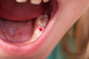 Installation of a colored red filling in a milk tooth for a child. Colored fillings in dentistry for children. Treatment of pulpitis and deep caries, close-up photo