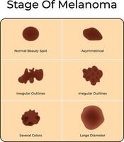 Stage of Melanoma Science Design Illustration Diagram vector