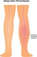 Deep Vein Thrombosis Science Design Illustration Diagram vector