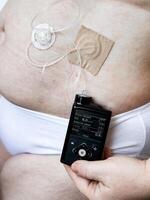Medical device for diabetes management with insulin pump on patients abdomen photo