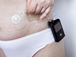 Closeup of womans glucose monitoring and insulin pump device photo
