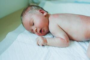 A newborn baby is lying on a diaper with a red rash on his body. Sweating of a newborn child. photo