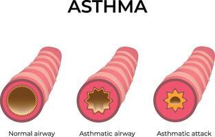 Asthma Normal Airway Asthmatic Airway Asthmatic Attack Design Illustration vector