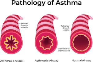 Pathology of Asthma, Asthma Normal Airway Asthmatic Airway Asthmatic Attack vector