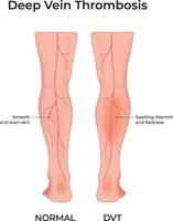 Deep Vein Thrombosis Design Illustration vector
