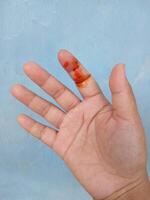 A dog bite wound and blood on hand. Infection and Rabies concept.Sarting of Rabies. photo