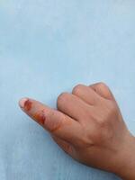 A dog bite wound and blood on hand. Infection and Rabies concept.Sarting of Rabies. photo