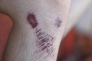 Wound and scab on skin of knee. Concept, physical injury from accident. It can be scar on skin after it's dry. photo