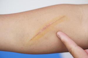Scratch wound on arm skin. Concept, physical injury from accident. It can be scar on skin after it's dry. photo