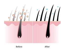 Before and after the mechanism of gray hair coverage shampoo with scalp layer illustration isolated on white background. Coloring shampoo, Herbal color serum, hair care concept illustration. vector