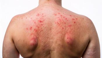 close-up of severe heat rash on the back with inflamed red bumps and irritation for dermatology and medical presentations photo