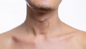 macro shot of a scar on the neck caused by a wire injury during sports, thin linear scar tissue with detailed healing process and subtle skin changes in isolated white background photo