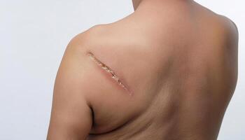 close-up of a deep scar on the upper back caused by a sharp object, showing uneven texture and healing process in isolated white background photo