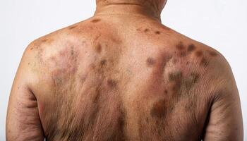 close-up view of hyperpigmented age spots and mottled skin on an elderly back with uneven skin tone on isolated white background photo