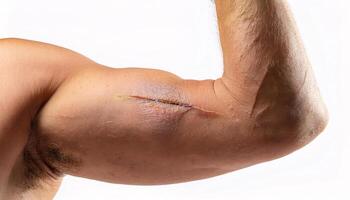 detailed view of a large scar from a cut on the flexed bicep, showing uneven healing in isolated white background photo