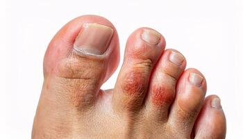 close-up of athlete's foot with visible redness, scaling, and irritation on the toes, showing fungal infection symptoms on isolated white background for medical and educational purposes photo