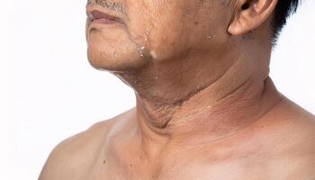 close-up of sagging skin under the chin with visible folds, wrinkles, and uneven texture in isolated white background photo