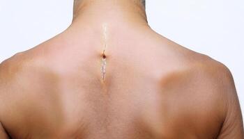 macro image of a scar on the upper back caused by a fishing hook, small but noticeable, showing healing process and detailed skin texture in isolated white background photo