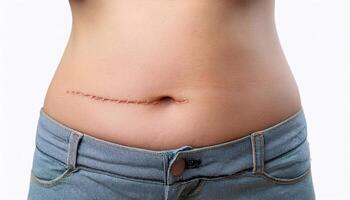 close-up of a c-section surgical scar on the lower abdomen, showing detailed stitch marks and skin healing process in isolated white background photo