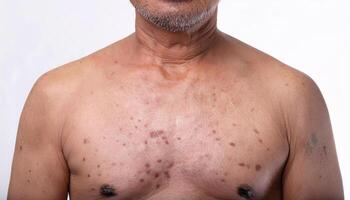 detailed image of freckled and aged skin on the chest and collarbone with noticeable uneven tone and pigmentation in isolated white background photo