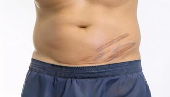 close-up of a c-section surgical scar on the lower abdomen, showing detailed healed stitch marks and skin texture in isolated white background photo
