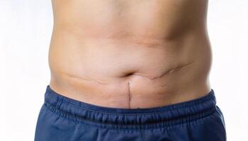 Close-up of a surgical scar from an emergency procedure on the abdomen, faint and clean in isolated white background photo