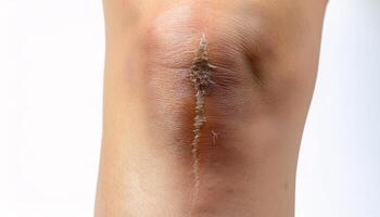 close-up of a scar on the shin caused by a fall on rocky terrain, featuring slightly jagged edges and textured healing in isolated white background photo