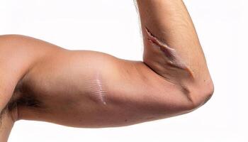 detailed view of multiple scars from cuts on the flexed bicep, showing healing process and uneven scar texture in isolated white background photo