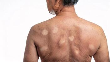 close-up of vitiligo patches and hyperpigmentation on the back of an elderly person showing uneven skin tone on isolated white background photo