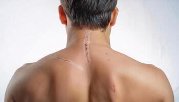close-up of a scar on the back caused by an accidental scratch from a metal fence, showcasing healing process and visible skin details in isolated white background photo