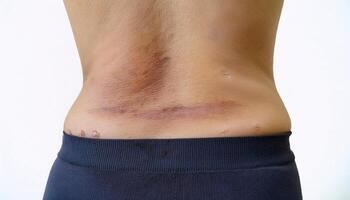 close-up of a scar on the lower back caused by falling off a tree, showcasing uneven texture and healing marks in isolated white background photo