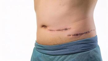 close-up of a surgical scar from an emergency abdominal procedure with faint and clean healing in isolated white background photo