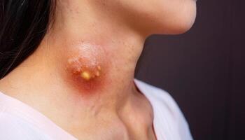 macro view of a large neck boil with inflamed red skin and pus-filled center, close-up medical dermatology image photo